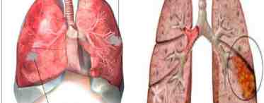 Плеврит туберкулезный: виды, причины и лечение